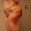 1  week PO Bruising from lipo. I bruise very easily.