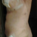 6 days post op