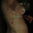 6 days post op