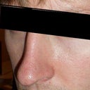 before injections