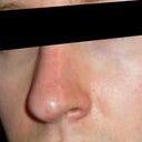 after injections