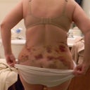 super bruised back!!! and had no lipo there!