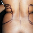 pre-op (larger on left side) 