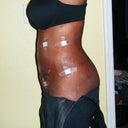2 days post-op