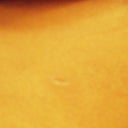 scar below my left breast (center of photo)19 days post-op, barely visable