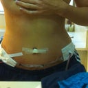 Day 5 Post op - definitely more swelling
