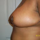 1 Week Post Opt