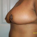 1 Week Post Opt