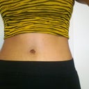 4 months post op tummy tuck. I am so happy Dr Pantoja hooked me up:)