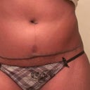 7 month postop... scar is dark and raised :-(
