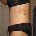 POD #3 Side View.  Some bruising from lipo.