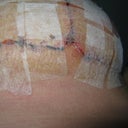 Day 9, Right under...the stitches I pulled.