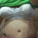 front 1 week PO I am really swollen today!!!