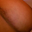right boob side scarring