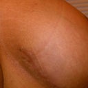 inner boob scarring left side