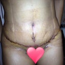 I still can't walk up straight . Felt so strange once I took my compression garment off! I was so squished ! wish  could clean my own insition, i hate seeing dry blood. But because of the tape i can take full showers. My next appointment is in one week.