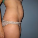 Day before surgery