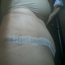 Right side and my TT is an extended. IU asked him why he went so far back and he said in order to get more of my stomach of he had too and I trust him so just gotta deal with what was delt to me.