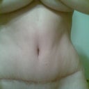 6 WEEKS AFTER (Scar)