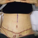 This is on day 6, post surgery.  All post pics thus far are taken laying down.