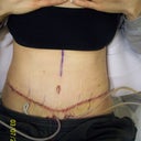 Day 6 post op.  Tummy sutures are removed and all but 4 belly button stitches are gone. One drain (the first one to the left) has been pulled.