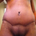 TT scar 4 months and a week