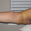 4 days after smartlipo