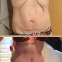 Before and after 5 weeks post opp