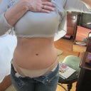3/29/13 - 2 years post TT & 1 month post dog ear removal! Cant see scar!  Marks are from jeans