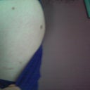 You can see broken blood vessels by my shirt strap, they are straight lines from my bra straps :-(