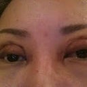 both eyes