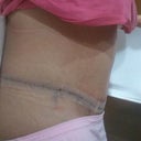 2 DPO Side...you can seemy long scar in this one