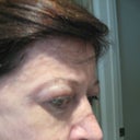 side view of the upper lids, edema and also dry eye condition