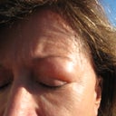 edema with very thin skin almost like a bubble bluish skin