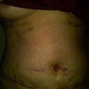 day after surgery