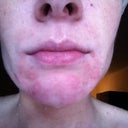 I hope I don't make anyone throw up.. this is how my chin look 2 weeks prior to treatment