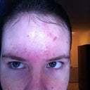 and this is my forehead.. I know..pretty bad.