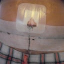 2days post op - you can see where my belly button is ouzing just a wee bit!