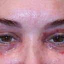 The first day.  My main procedure was CO2 laser of upper and lower eyelid, but he spot lasered small spots on my face too.