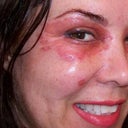 Second day, I look like I'm wearing a Mardi Gras Mask, or Star Trek. Spot lasering on face too.