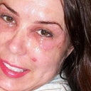 I had to soak the dead skin daily with vinegar and water compresses. And wipe off any dead tissue. Exfoliation is needed daily.