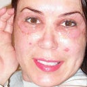 I had to soak the dead skin daily with vinegar and water compresses.  And wipe off any dead tissue to prevent infection.