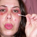 The skin is so raw it has little cracked bleeding areas.