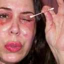The skin is so raw it has little cracked bleeding areas.