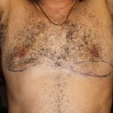 See marked areas. He wants to cut out marked areas and do an "Ankerlift". We discussed that option before the surgery and I told him I will not do an "Ankerlift" because of the scars and he told me, he even gave it to me in writing, that he is confident the surgery will produce good results even without the 'Ankerlift". Again I let you be the judge of that.