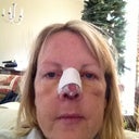 Day4 post op