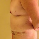 Side Post Op Day 6 - still can't stand up straight.  I don't think I'll have a sway back anymore which is good because I had a lot of low back pain before the surgery.