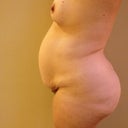 Another side angle pre-op.