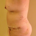 Another side view day 6 post op.  You can see some of the bruising from the lipo.