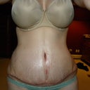 3 Weeks post op